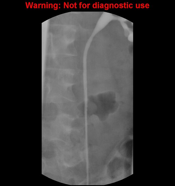 File:Normal retrograde pyelography of a native and transplant kidney (Radiopaedia 40480-43054 Native kidney 11).jpg