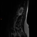 Normal spine MRI (Radiopaedia 77323-89408 Sagittal T2 12).jpg