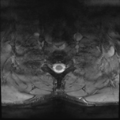 Normal trauma cervical spine (Radiopaedia 41017-43762 Axial T2 28).png