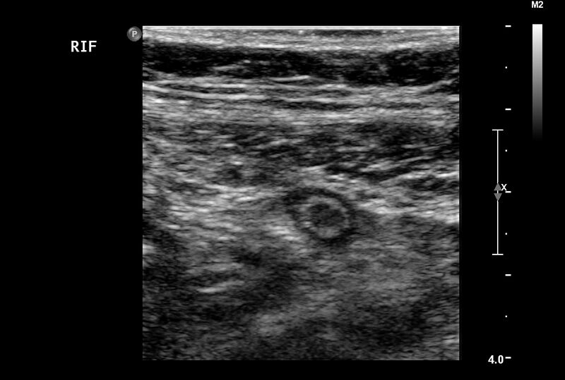 File:Normal vermiform appendix (Radiopaedia 9553-40788 A 1).jpg