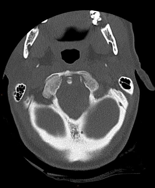 File:Occipital condyle fracture (Radiopaedia 61165-69056 D 7).jpg