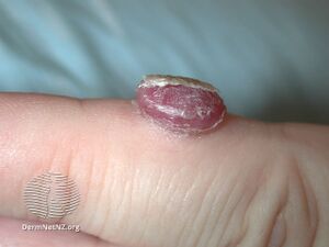 Pyogenic granuloma (DermNet NZ doctors-lesions-images-pg4).jpg