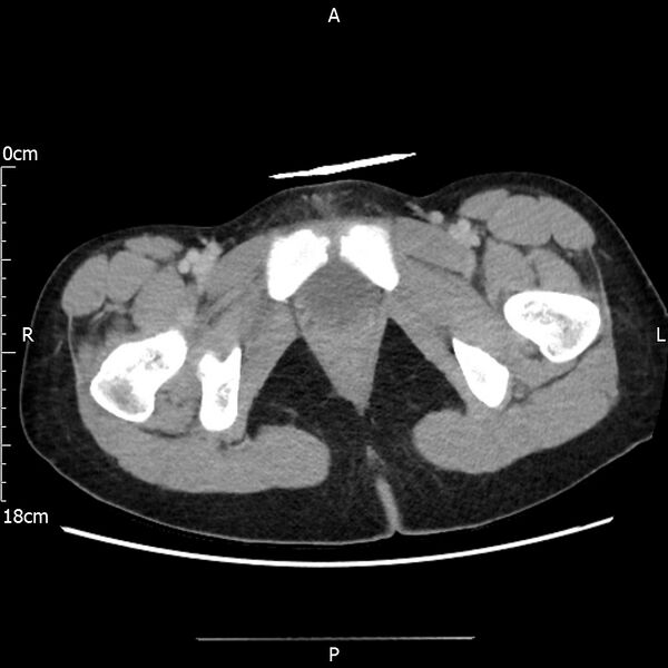 File:AAST grade IV kidney injury with CEUS follow-up (Radiopaedia 72353-82877 Axial C+ portal venous phase 80).jpg