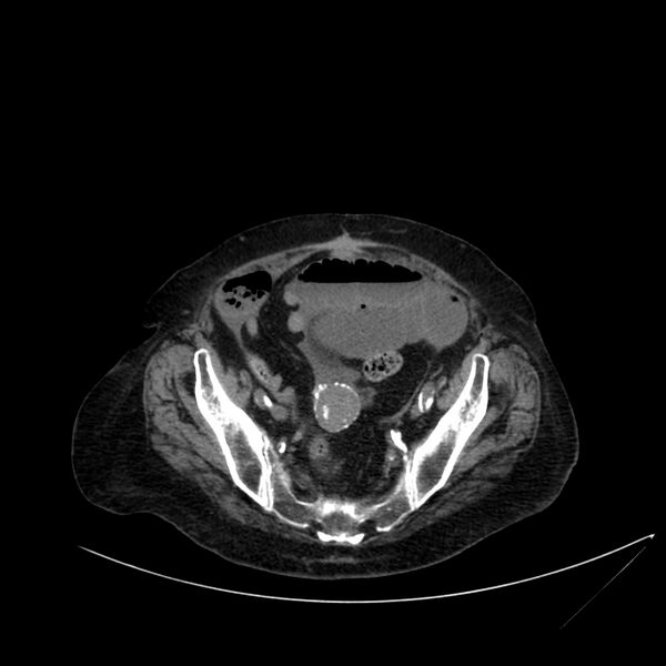 File:Abdominal aortic aneurysm - impending rupture (Radiopaedia 19233-19246 Axial non-contrast 101).jpg
