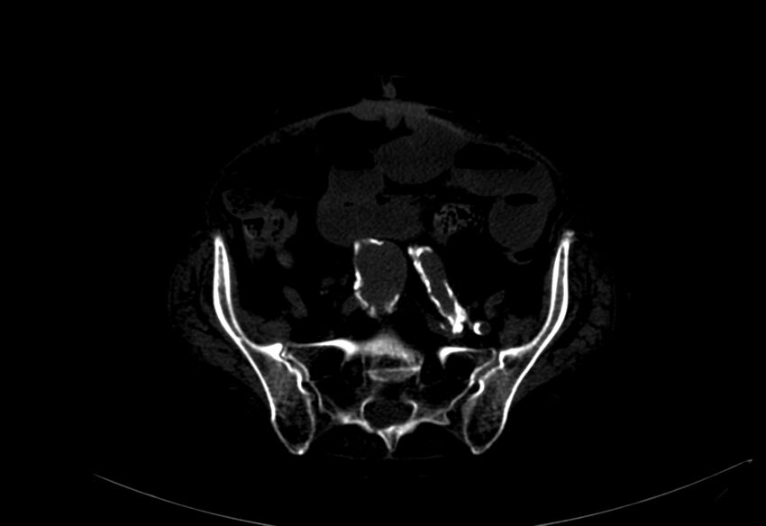 Abdominal aortic aneurysm - impending rupture (Radiopaedia 19233-19246 B 43).jpg