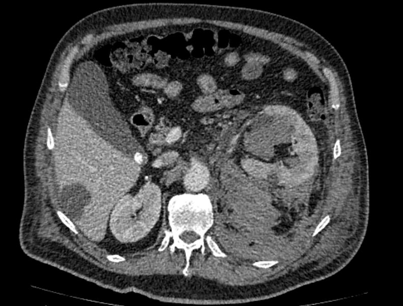 File:Abdominal aortic aneurysm rupture (Radiopaedia 54179-60362 Axial C+ portal venous phase 27).jpg