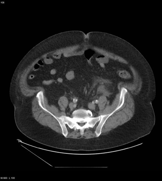 File:Abdominal aortic aneurysm with intramural hematoma then rupture (Radiopaedia 50278-55631 Axial C+ arterial phase 99).jpg
