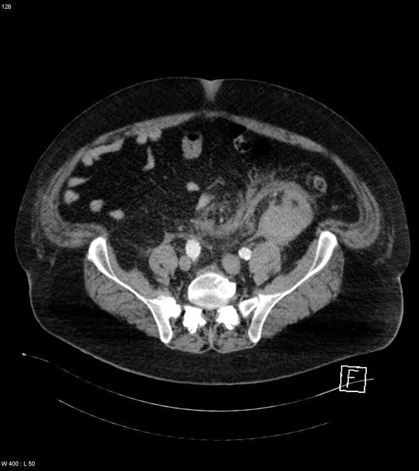 Abdominal aortic aneurysm with intramural hematoma then rupture (Radiopaedia 50278-55632 Axial C+ arterial phase 125).jpg