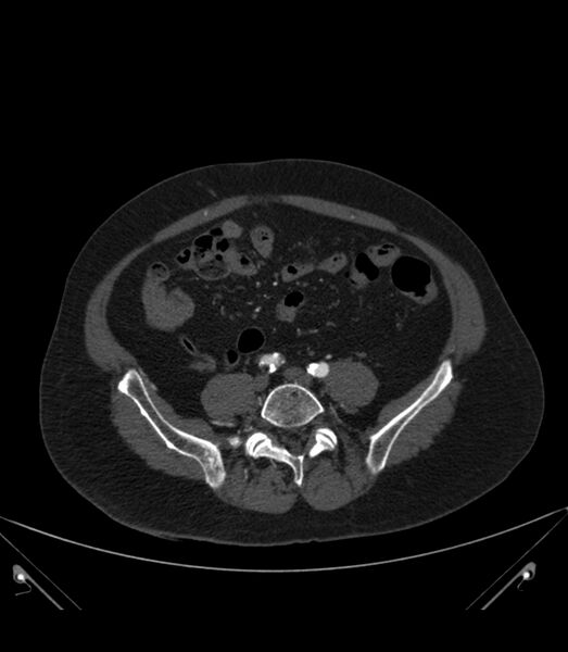 File:Abdominal aortic aneurysm with thrombus fissuration (Radiopaedia 46218-50618 Axial C+ arterial phase 29).jpg