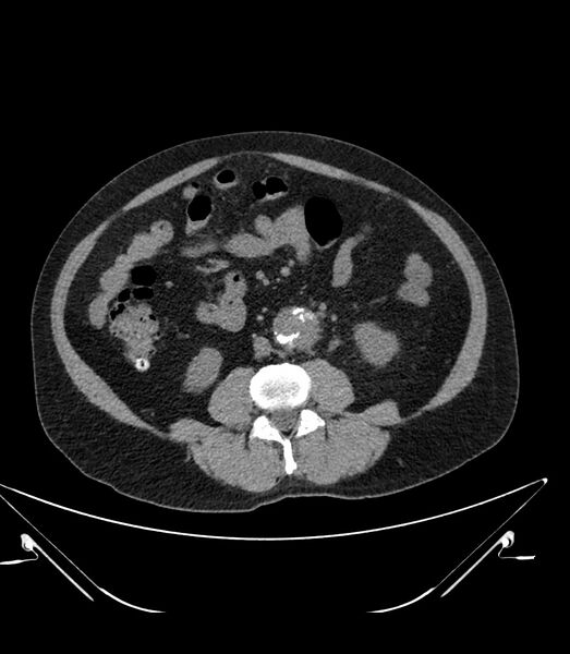 File:Abdominal aortic aneurysm with thrombus fissuration (Radiopaedia 46218-50618 Axial non-contrast 29).jpg