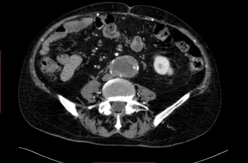 File:Abdominal aortic interposition tube graft and aneurysm thrombosis (Radiopaedia 71438-81857 Axial C+ arterial phase 114).jpg