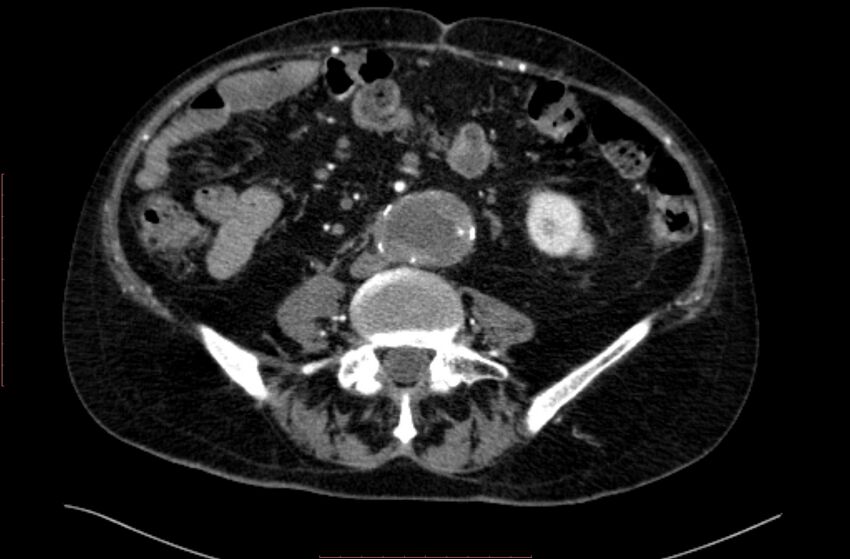 Abdominal aortic interposition tube graft and aneurysm thrombosis (Radiopaedia 71438-81857 Axial C+ arterial phase 114).jpg