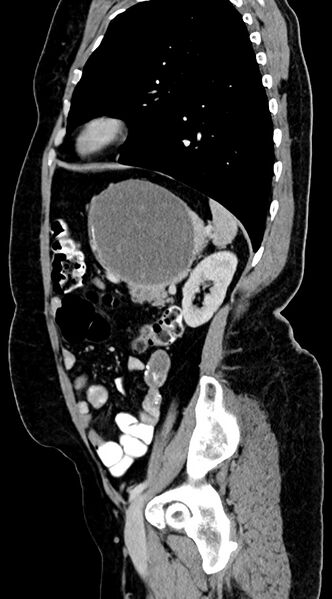 File:Abdominal hydatid disease (Radiopaedia 68223-77737 Sagittal C+ portal venous phase 20).jpg