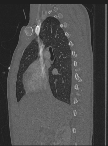 File:Abdominal multi-trauma - devascularised kidney and liver, spleen and pancreatic lacerations (Radiopaedia 34984-36486 Sagittal bone window 52).png