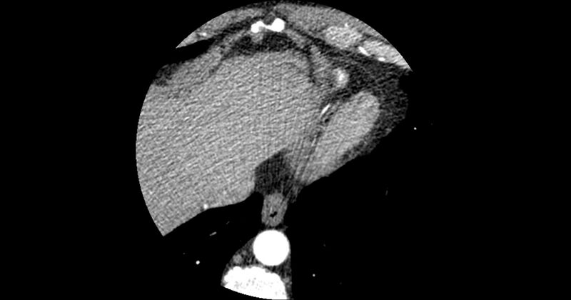 File:Aberrant left main coronary artery (ALMCA) arising from the right sinus with interarterial course (Radiopaedia 63251-71814 Axial C+ arterial phase 182).JPG