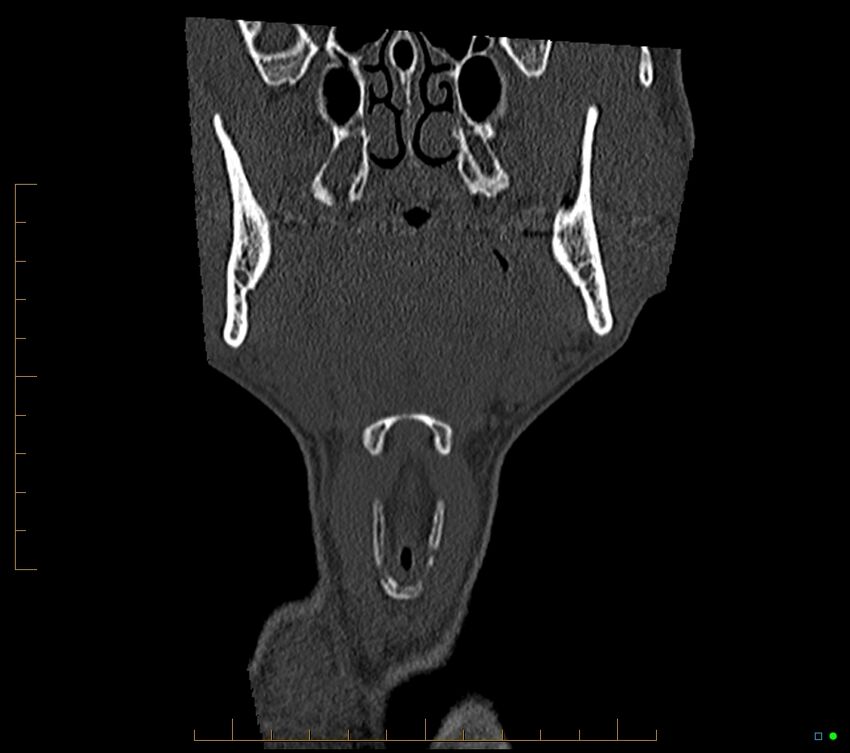 Accessory articulation of cervical transverse processes (Radiopaedia 82715-96933 Coronal non-contrast 13).jpg