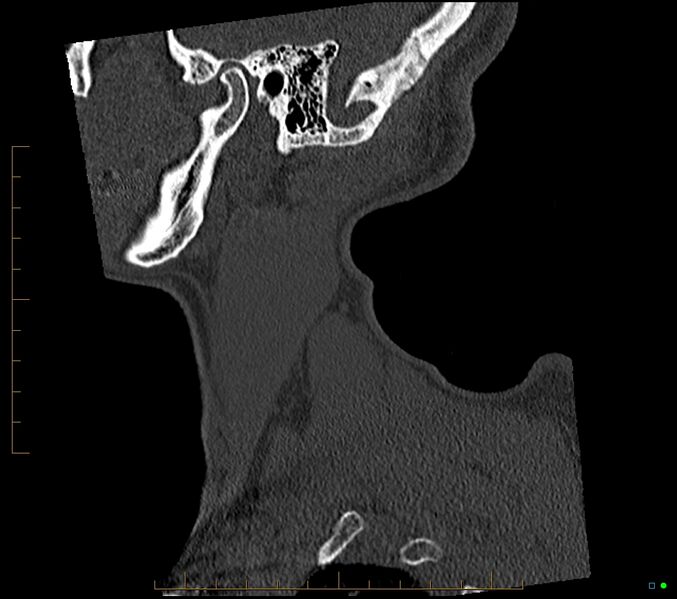 File:Accessory articulation of cervical transverse processes (Radiopaedia 82715-96933 Sagittal non-contrast 1).jpg