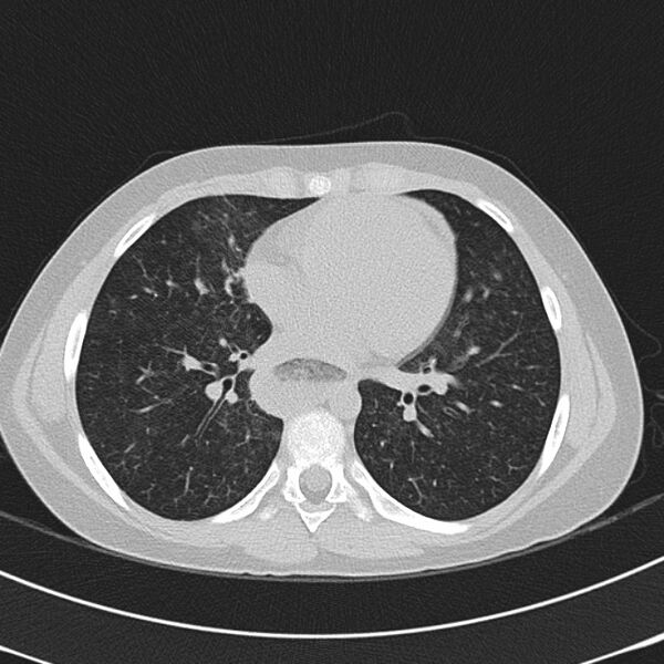 File:Achalasia (Radiopaedia 14946-14878 Axial lung window 45).jpg