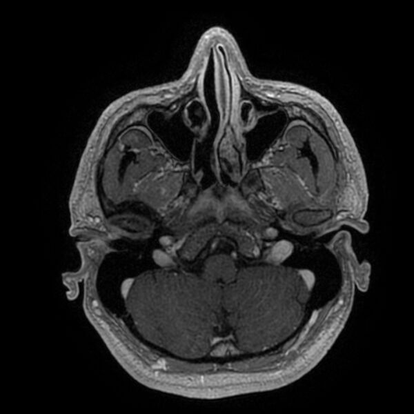 File:Acoustic schwannoma - intracanalicular (Radiopaedia 37247-39024 Axial T1 C+ 49).jpg