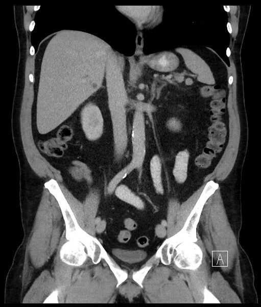 File:Acute-on-chronic pancreatitis (Radiopaedia 67286-76656 Coronal C+ portal venous phase 42).jpg