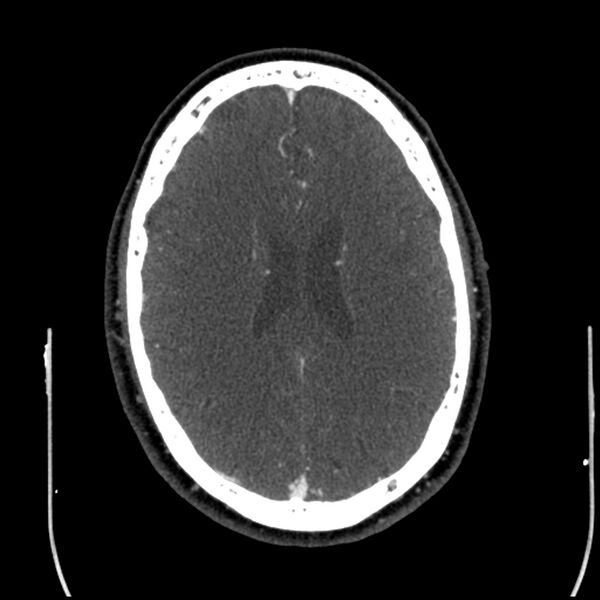 File:Acute A3 occlusion with ACA ischemic penumbra (CT perfusion) (Radiopaedia 72036-82527 Axial C+ arterial phase thins 33).jpg