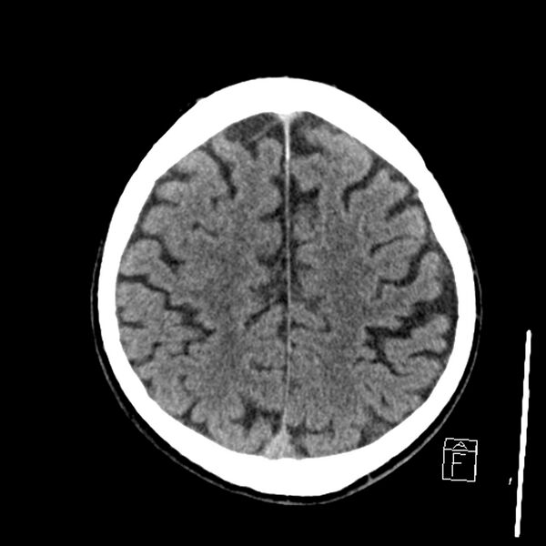 File:Acute P1 occlusion with PCA ischemia penumbra (CT perfusion) (Radiopaedia 72084-82586 Axial non-contrast 34).jpg