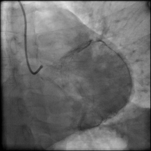 File:Acute anteroseptal myocardial infarction (Radiopaedia 68409-77946 LAO caudal (spider view) LAD and CX 68).jpg