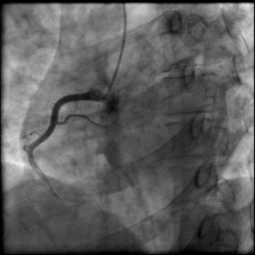 Acute anteroseptal myocardial infarction (Radiopaedia 68409-77946 RAO straight RCA 14).jpg