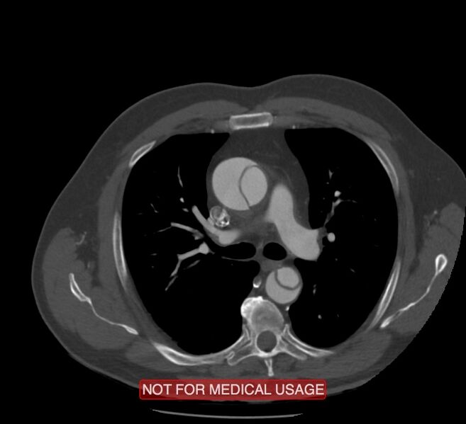 File:Acute aortic dissection - Stanford type A (Radiopaedia 40661-43285 Axial C+ arterial phase 20).jpg