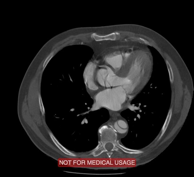 File:Acute aortic dissection - Stanford type A (Radiopaedia 40661-43285 Axial C+ arterial phase 41).jpg