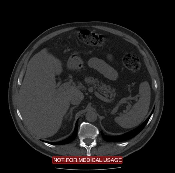 File:Acute aortic dissection - Stanford type A (Radiopaedia 40661-43285 Axial non-contrast 81).jpg