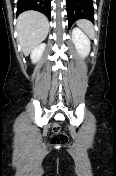 File:Acute appendicitis (Radiopaedia 22892-22918 Coronal C+ portal venous phase 47).png