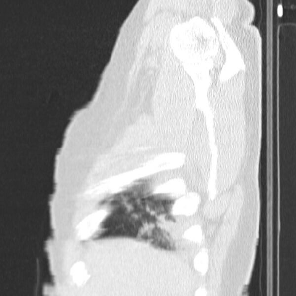 File:Acute aspiration pneumonitis (Radiopaedia 33605-34703 Sagittal lung window 11).jpg