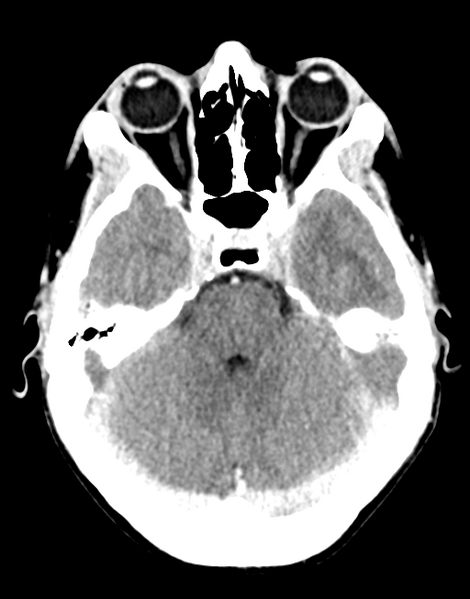File:Acute disseminated encephalomyelitis (ADEM) (Radiopaedia 65319-74348 Axial C+ delayed 10).png