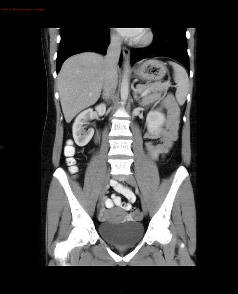 File:Acute gastritis (Radiopaedia 21043-20975 Coronal C+ portal venous phase 11).jpg