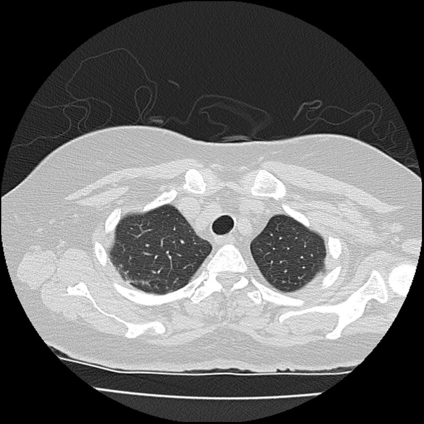 Acute interstitial pneumonitis (Radiopaedia 45404-49452 Axial lung window 14).jpg