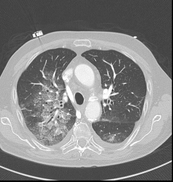 File:Acute myocardial infarction (Radiopaedia 23413-23481 lung window 11).jpg