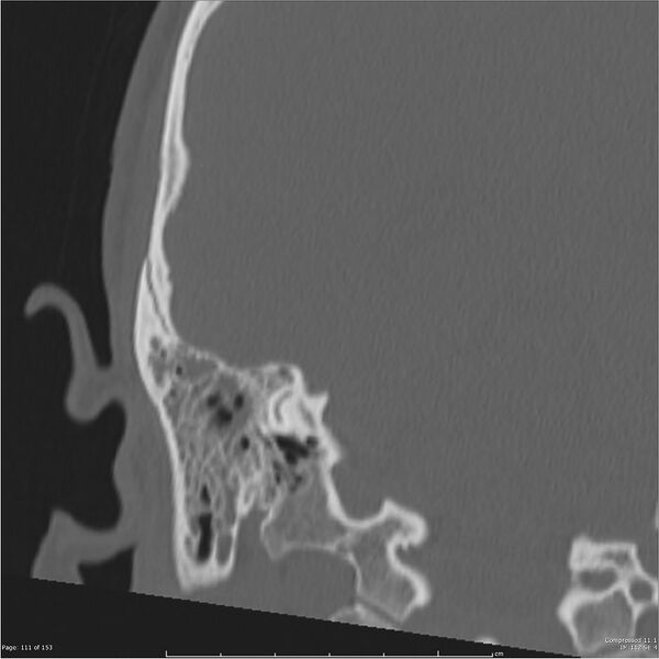File:Acute otomastoiditis (Radiopaedia 28276-28512 Coronal PTB bone window reformat 42).jpg