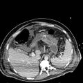 Acute pancreatic necrosis (Radiopaedia 13560-18501 Axial C+ portal venous phase 31).jpg
