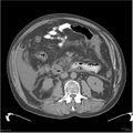 Acute pancreatitis (Radiopaedia 19135-19116 Axial non-contrast 25).jpg