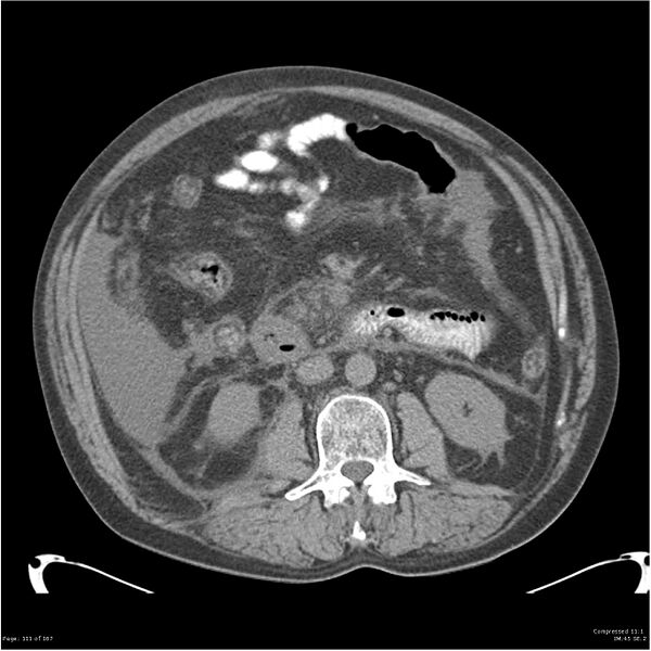 File:Acute pancreatitis (Radiopaedia 19135-19116 Axial non-contrast 25).jpg