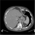 Acute pancreatitis (Radiopaedia 19135-19116 Axial non-contrast 5).jpg