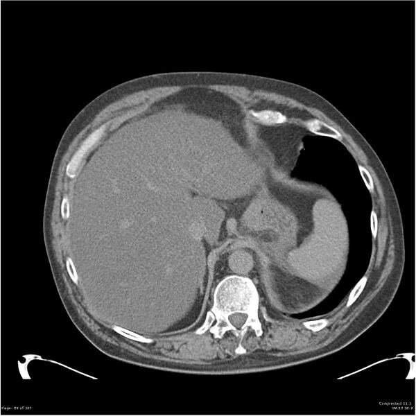 File:Acute pancreatitis (Radiopaedia 19135-19116 Axial non-contrast 5).jpg
