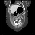 Acute pancreatitis (Radiopaedia 19136-19117 Coronal C+ portal venous phase 4).jpg