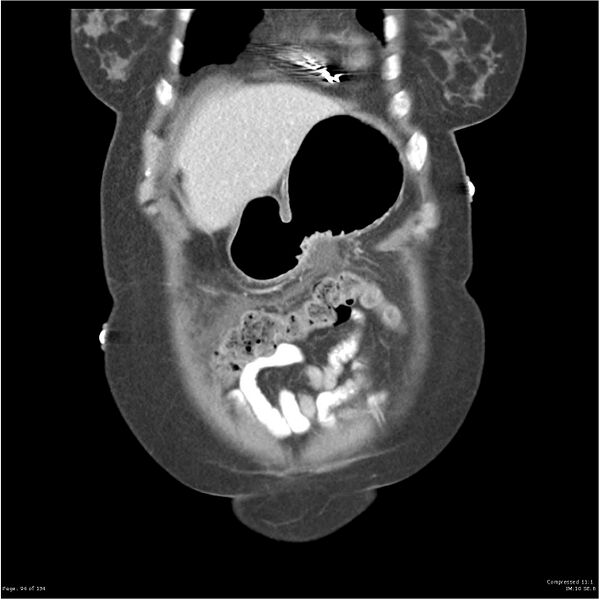 File:Acute pancreatitis (Radiopaedia 19136-19117 Coronal C+ portal venous phase 4).jpg