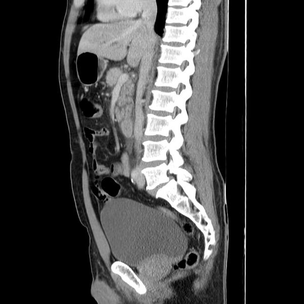 File:Acute pancreatitis (Radiopaedia 22572-22596 Sagittal C+ portal venous phase 26).jpg