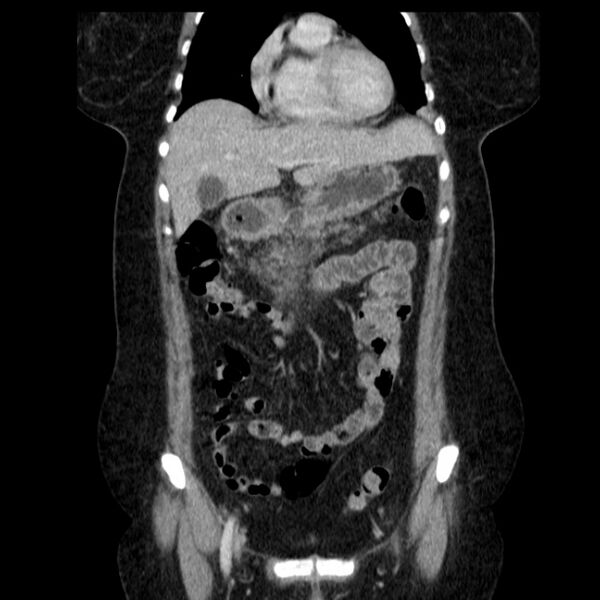 File:Acute pancreatitis - Balthazar C (Radiopaedia 26569-26714 Coronal C+ portal venous phase 24).jpg