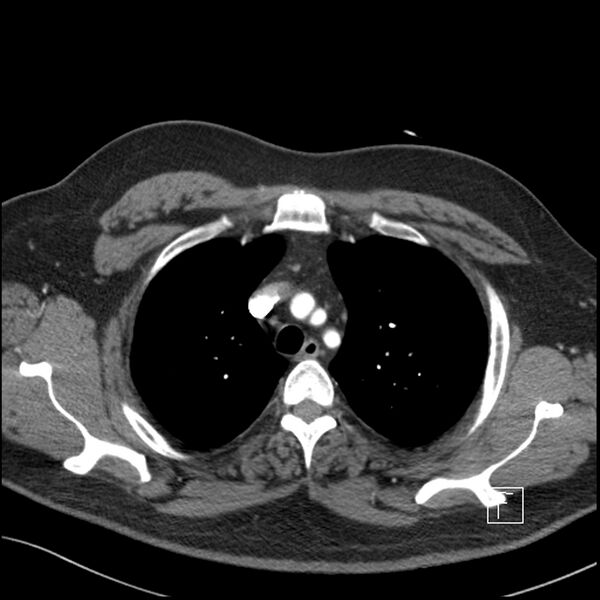 File:Acute pulmonary embolism with pulmonary infarct (Radiopaedia 73062-83768 Axial C+ CTPA 15).jpg