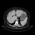 Acute pyelonephritis (Radiopaedia 25657-25837 Axial renal parenchymal phase 20).jpg