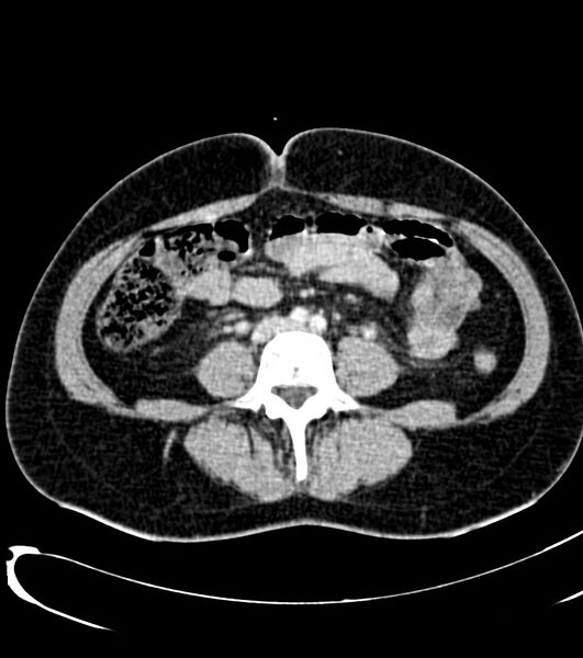 File:Acute pyelonephritis (Radiopaedia 40264-42816 Axial C+ portal venous phase 44).jpg